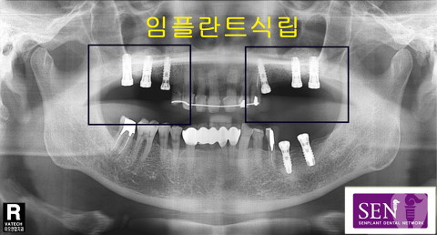 상악_~1