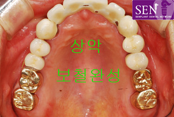 상악완~1