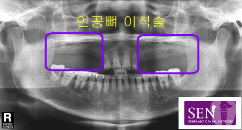 이차영-인공뼈이식술