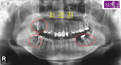 치료전