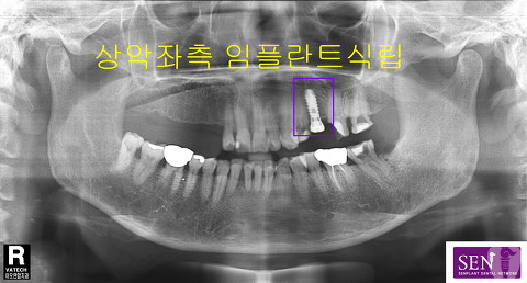 파노-1차_식립