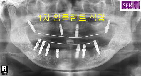 파노-1차_식립