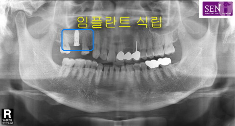 파노-1차식립