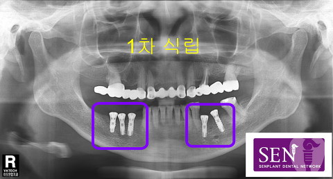 파노-1차식립