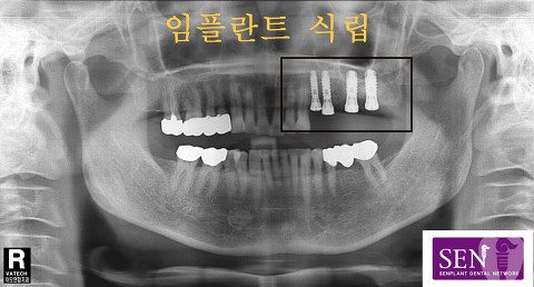 파노-~2