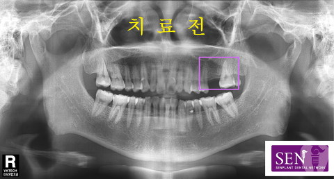 파노-~2