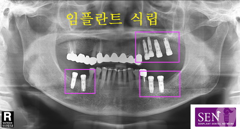 파노-~2