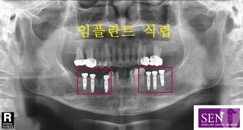 파노-~2