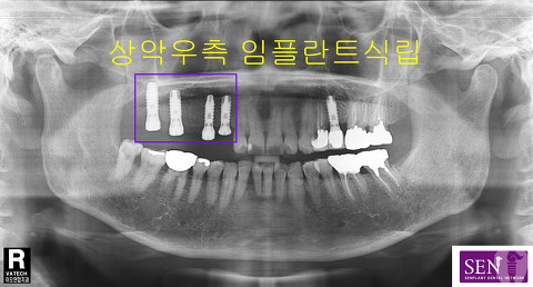 파노-2차_식립