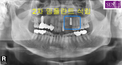 파노-2차_식립