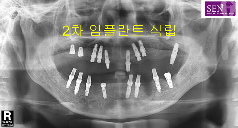 파노-2차식립