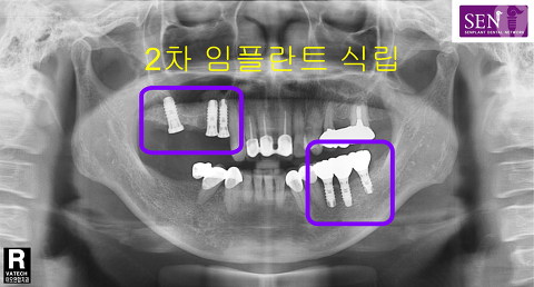 파노-2차식립