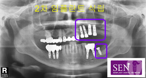 파노-2차식립