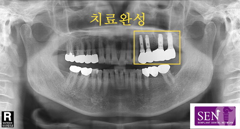 파노-~4