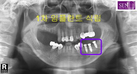 파노-_1차식립