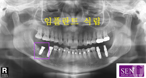 파노-_최종적_식립