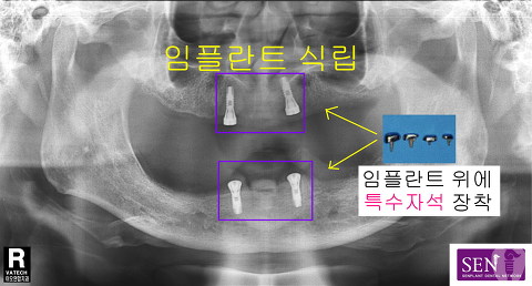 파노-마그네틱_장착