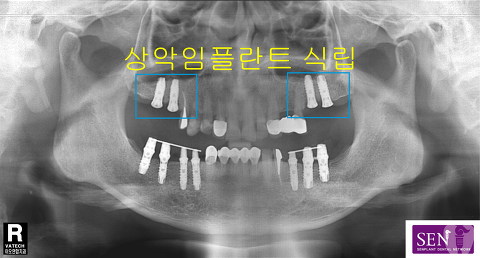 파노-상악식립