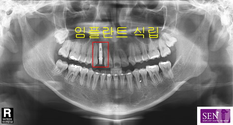 파노-식립