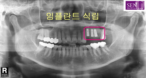 파노-식립