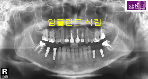 파노-식립