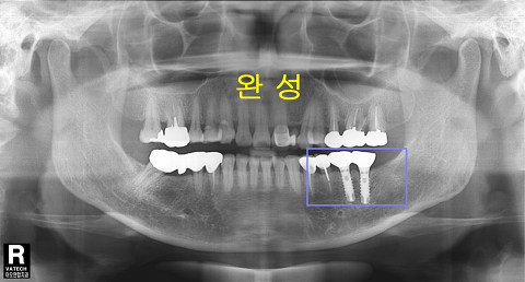 파노-완성