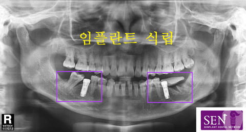 파노-우_식립_및_이식