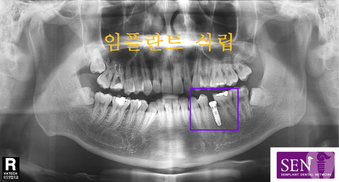 파노-임플란트_식립