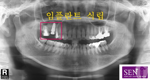 파노-임플란트_식립