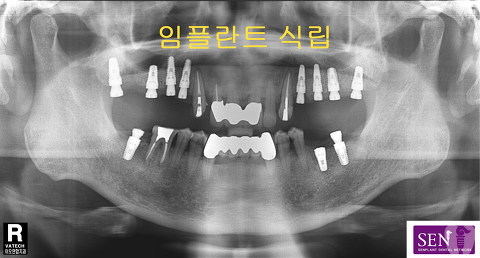 파노-임플란트_식립