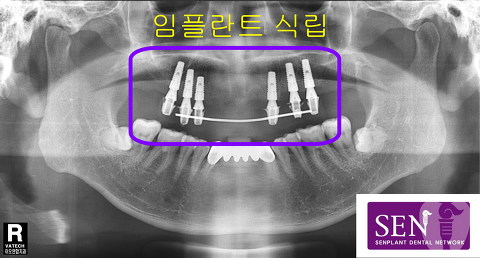 파노-임플란트_식립