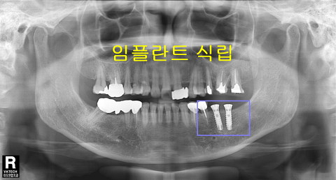 파노-임플란트식립