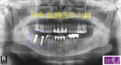 파노-임플란트식립1