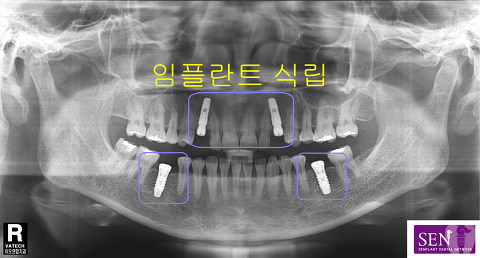 파노-임플란트식립