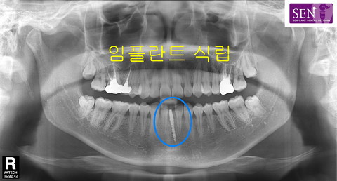 파노-임플란트식립