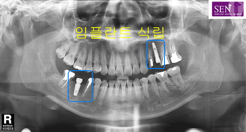 파노-임플란트식립