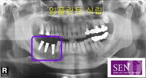 파노-임플란트식립