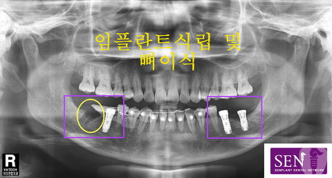 파노-좌_식립_및_우_이식