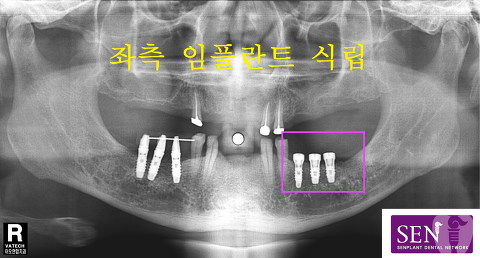 파노-좌측식립