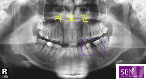 파노-치료전