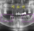 파노-치료전