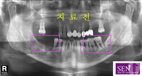 파노-치료전