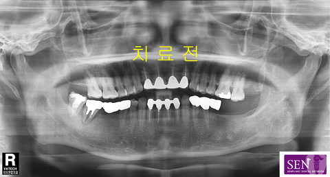 파노-치료전