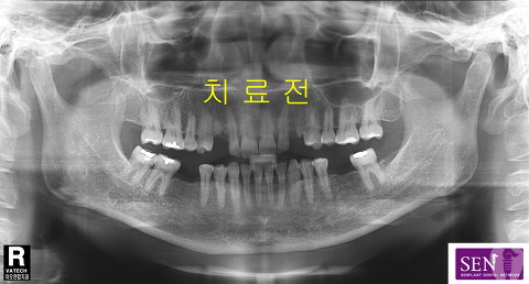 파노-치료전