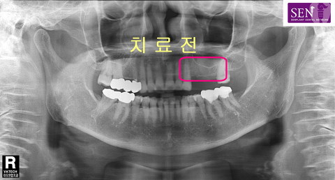 파노-치료전