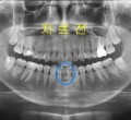 파노-치료전