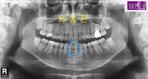 파노-치료전