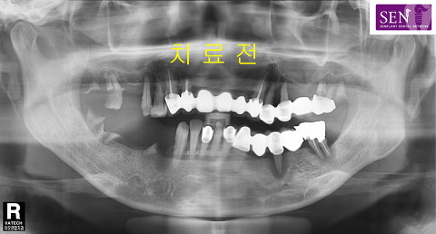 파노-치료전