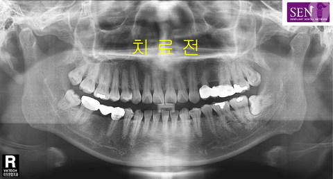 파노-치료전