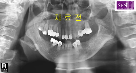 파노-치료전